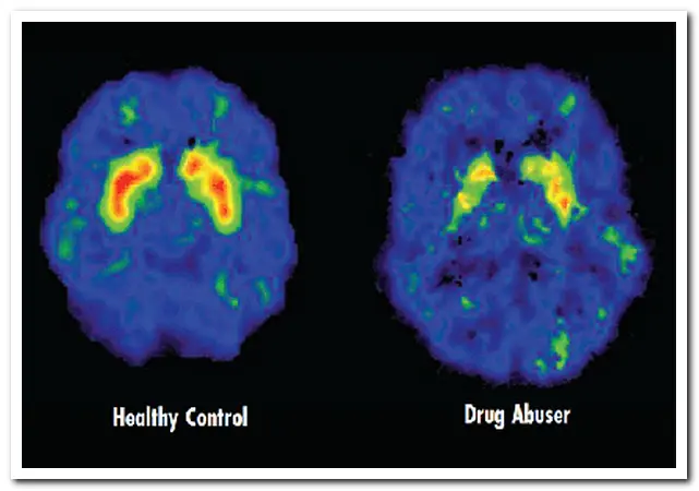healthy brain verses drug addicted brain