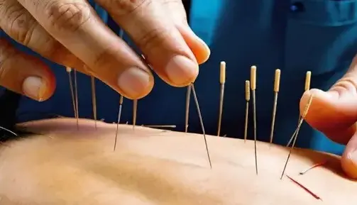 Acupuncture is sometimes used in holistic drug rehab centers